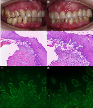 (a, b) Erosive and erythematous plaques with a diameter of up to 1cm affecting the marginal, interdental, and attached gingiva. (c, d) Representative histologic image from the biopsy showing a subepidermal blister and multiple inflammatory cells including eosinophils (hematoxylin and eosin, ×100 (c) and ×200 (d)). (e, f) IFD test showing (e) linear deposition of IgG (×200) and (f) C3 along the dermoepidermal junction (×200).
