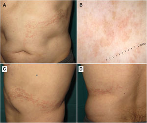 Hallazgos clínicos y dermatoscópicos. (A-D) Múltiples pápulas planas, brillantes y eritematosas a lo largo de las líneas de Blaschko. El examen dermatoscópico reveló puntos rojos y grises sobre un fondo parduzco.