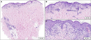 (A) Biopsia punch que incluye epidermis, dermis y tejido subcutáneo. La dermis superficial muestra un infiltrado inflamatorio moderado con extensión perianexial profunda (hematoxilina-eosina [HE], x 20). (B-C) Epidermis ligeramente hiperplásica, degeneración vacuolar de la capa basal y ocasionales queratinocitos apoptóticos. El infiltrado inflamatorio es principalmente linfoplasmocitario, con una distribución intersticial y perivascular y exocitosis linfocitaria hacia la capa basal epidérmica. Además, se observa un ligero edema de la dermis superficial, extravasación hemática y melanófagos (hematoxilina-eosina [HE], x80 [b] y x200 [c]).
