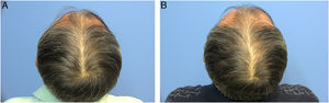 Male patient with AGA before and 6 months into subcutaneous botulinum toxin injections (Group B).