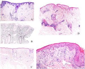 (A) Presence of concentric perinfundibular fibrosis, easily identifiable with haematoxylin and eosin staining, in a case of scarring alopecia. (B) Histochemical staining using the orcein technique, demonstrating the destruction of elastic fibres in the perinfundibular areas of a case of scarring alopecia. (C) Example of androgenetic alopecia (non-scarring), with marked follicular miniaturisation. (D) Biopsy of an alopecic patch in a patient with lupus erythematosus. Presence of a superficial and deep perivascular inflammatory infiltrate, along with perianexal involvement, dermoepidermal junction blurring, and epidermal atrophy. (E) Detail of the same case shown in figure LUPUS showing vacuolar degeneration of the basal layer of the epidermis with some apoptotic keratinocytes.