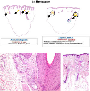 (A) Sebaceous glands in psoriatic alopecia and alopecia areata. In psoriatic alopecia, sebaceous glands show a reduction in size and number, while in alopecia areata, the mean volume of sebaceous glands remains unchanged with an overall reduced volume. (B) Sebaceous gland in an example of psoriatic alopecia, with an increased proportion of immature sebocytes, characterized by smaller, more basophilic cytoplasm and less vacuolation vs mature sebocytes. (C) Sebaceous glands in an example of alopecia areata. Glands are predominantly composed of mature sebocytes with pale, vacuolated cytoplasm.