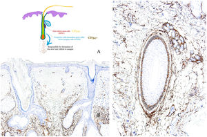 (A) Diagram illustrating the distribution of hair follicle stem cells (HFSC), primarily located in the bulge, as well as progenitor cells, considered as secondary germ cells and direct progeny of the HFSC (located along the outer root sheath). Progenitor cells are responsible for the formation of new hair follicles in the anagen phase. While hair follicle stem cells are CD34−, progenitor cells are CD34+. (B) Immunohistochemical staining for CD34 in a case of androgenetic alopecia, showing the absence of progenitor cells. (C) Immunohistochemical staining for CD34 in a case of alopecia areata, demonstrating strong expression in the outer root sheath of the hair follicle.