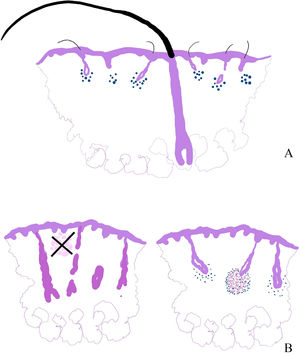 (A) Diagram showing an explanation of cases of alopecia areata of clinical presentation as refractory alopecia areata with single hairs. In these cases, a relatively preserved isolated terminal hair is seen amidst a population of miniaturized hairs affected by the disease. (B) The granulomatous variant of alopecia areata is not defined by the presence of granulomas in any location of the biopsy. Instead, granulomas are located in the hair follicle bulb.