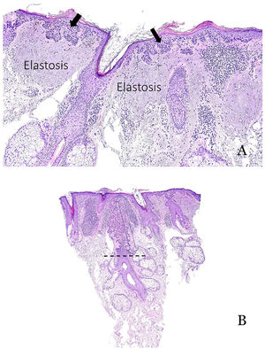 (A) Typical example of actinic keratosis affecting the epidermis but sparing the hair follicle. Prominent solar elastosis is observed in the dermis. (B) Example of actinic keratosis affecting the hair follicle. In such cases, it is important to include the depth of follicular involvement in the report.
