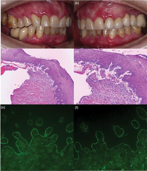 (a y b) Placas erosivas y eritematosas con un diámetro de hasta 1cm, que afectaron las encías marginales, interdentales y adjuntas. (c y d) Imagen histológica representativa de la biopsia, que muestra una ampolla subepidérmica y múltiples células inflamatorias incluyendo eosinófilos (hematoxilina y eosina, ×100 [c] y ×200 [d]). (e, f) Prueba inmunofluorescencia directa que muestra (e) depósito lineal de IgG (×200) y (f) C3 a lo largo de la unión dermoepidérmica (×200).