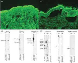 (a y b) Imágenes de inmunofluorescencia indirecta. (a) El IgG de la paciente reacciona en la zona de la membrana basal, disolución 1:10 (×200). (b) El IgG de la paciente reacciona en el lado epidérmico de la sección, disolución 1:40 (×200). (c y d) Inmunoblot que muestra IgG vs. los dominios C-terminal y LAD-1 (HaCaT) de BP180. Los resultados fueron negativos para los extractos epidérmico (desmogleína 1 y 3) y dérmico, BP180 NC16a, y Laminina-332.