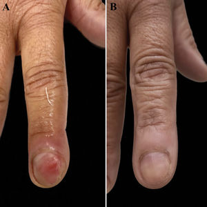 A) Acropaquia digital del segundo dedo derecho con eritema subungueal leve; B) El mismo dedo transcurridos 4 meses del procedimiento.