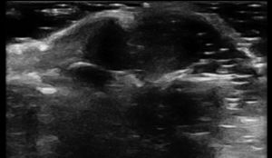 Nódulo subungueal hipoecoico circunscrito, avascular en Doppler, con sombra acústica posterior parcial.