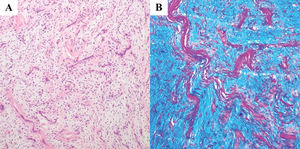 Neoplasia mesenquimatosa benigna con aspecto mixoide y vascularidad prominente (A: H&E, ×10) y abundante producción de mucina, confirmada mediante tinción específica (B: hierro coloidal, ×10).