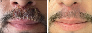 (A) Erythematous–edematous-crusted lesion covering almost the entire upper lip, extending to both nasal vestibules. (B) Clinical resolution of the condition after the combination of systemic and topical terbinafine for 8 weeks.