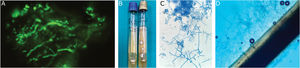 (A) Direct examination of the sample with calcofluor white, showing abundant septate hyphae. (B) Growth of flat, powdery colonies, with yellow margins and orange pigment on the reverse after 10 days of incubation at 30°C on Sabouraud agar with chloramphenicol (yellow cap) and Sabouraud agar with chloramphenicol and actidione (blue cap). (C) Microculture showing septate hyaline hyphae with occasional spiral hyphae typical of the causative agent, spherical microconidia, and multi-septate smooth-walled macroconidia. (D) Positive hair perforation test on neonatal hair, showing conical images with a base on the outer part and apex on the inner part of the hair, demonstrating invasive capacity in the hair.