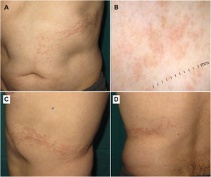 Clinical and dermoscopic findings. (A–D) Multiple flat, shiny, and erythematous papules along Blaschko