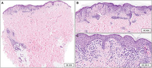 (A) Punch biopsy including epidermis, dermis, and subcutaneous tissue. The superficial dermis shows a moderate inflammatory infiltrate with deep periannexial extension (hematoxylin–eosin [HE], ×20). (B, C) Slightly hyperplastic epidermis, vacuolar degeneration of the basal layer, and occasional apoptotic keratinocytes. The inflammatory infiltrate is mainly lymphoplasmacytic, with an interstitial and perivascular distribution and lymphocytic exocytosis into the epidermal basal layer. Additionally, slight edema of the superficial dermis, extravasated blood, and melanophages are observed (hematoxylin–eosin [HE], ×80 [b] and ×200 [c]).
