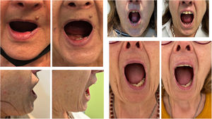 Patients treated with hyaluronidase and laser showed improved oral aperture diameter and visible teeth in frontal views. From a lateral perspective, greater skin retraction was observed when opening the mouth after treatment.