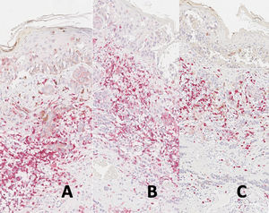 (A) Expresión de CD3 en melanoma con regresión. (B) Expresión de CD4 en melanoma con regresión. (C) Expresión de CD8 en melanoma con regresión.