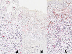 (A) Expresión de CD25 en melanoma con regresión. (B) Expresión de FOXP3 en melanoma con regresión. (C) Expresión de PD1 en melanoma con regresión.
