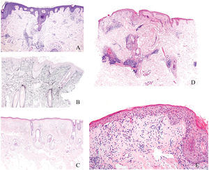 A) Presencia de fibrosis perinfundibular concéntrica, fácilmente identificable con la tinción de hematoxilina y eosina, en un caso de alopecia cicatricial. B) Tinción histoquímica mediante la técnica de la orceína, que demuestra la destrucción de las fibras elásticas en las zonas perinfundibulares de un caso de alopecia cicatricial. C) Ejemplo de alopecia androgenética (no cicatricial), con marcada miniaturización folicular. D) Biopsia de una mancha alopécica en un paciente con lupus eritematoso. Presencia de un infiltrado inflamatorio perivascular superficial y profundo, junto con afectación perianexial, unión dermoepidérmica borrosa y atrofia epidérmica. E) Detalle del mismo caso de la figura LUPUS que muestra degeneración vacuolar de la capa basal de la epidermis con algunos queratinocitos apoptóticos.