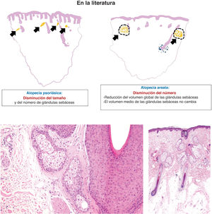 A) Glándulas sebáceas en la alopecia psoriásica y la alopecia areata. En la alopecia psoriásica, las glándulas sebáceas muestran una reducción de tamaño y número, mientras que en la alopecia areata, el volumen medio de las glándulas sebáceas permanece inalterado con un volumen global reducido. B) Glándula sebácea en un ejemplo de alopecia psoriásica, con una mayor proporción de sebocitos inmaduros, caracterizados por un citoplasma más pequeño y basófilo y una menor vacuolización frente a los sebocitos maduros. C) Glándulas sebáceas en un ejemplo de alopecia areata. Las glándulas están compuestas predominantemente por sebocitos maduros con citoplasma pálido y vacuolado.