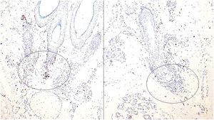 Tinción inmunohistoquímica con CD117 (CKIT) que demuestra la presencia de mastocitos en el infiltrado inflamatorio peribulbar de la alopecia areata.