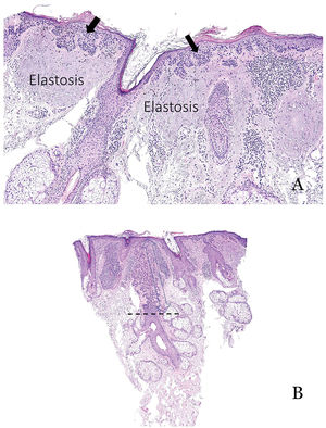 A) Ejemplo típico de queratosis actínica que afecta a la epidermis pero no al folículo piloso. Se observa una elastosis solar prominente en la dermis. B) Ejemplo de queratosis actínica que afecta al folículo piloso. En estos casos, es importante incluir en el informe la profundidad de la afectación folicular.