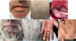 Clinical images of mpox cutaneous lesions: confluent pseudopustules with a depressed necrotic center and perilesional erythema affecting the face (A) and trunk (B) on hospitalization day 1. Ulcerated lesions in the oral cavity and necrotic lesion on the right palatine tonsil with uvular displacement (C). Worsening of the cutaneous lesions on hospitalization day 4: increased number and size of confluent pseudopustules with increased necrotic center on face (E), trunk (F), palms (E), and neck (G).