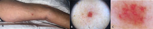 Imagen clínica y dermatoscópica. A. Pápula eritematosa de tacto elástico y 8mm de diámetro en la cara interna del brazo izquierdo. B. Múltiples vasos en sacacorchos sobre un fondo eritematovioláceo bien delimitado con alguna estructura blanquecina. C. Detalle: vasos en sacacorchos.