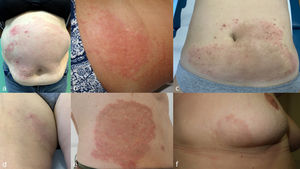 Gran placa anular que ocupa todo el abdomen, con el borde salpicado de pápulas, de la paciente 32 (a); placa semianular con borde papuloso en el abdomen de la paciente 33 (b); extenso eritema de configuración anular con bordes salpicados de pápulas y pigmentación central de la paciente 34 (c); otra placa en muslo en la paciente 34 (d); gran placa con tendencia a aclaramiento central y con numerosas pápulas de predominio en la periferia, en el paciente 35 (e); placa de configuración semianular en mama, con bordes con pápulas eritematosas, de la paciente 36 (f).