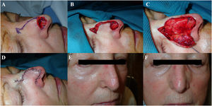 (A) Diseño del colgajo AIRNS. (B, C) Imágenes intraoperatorias tras la movilización del colgajo. (D) Imagen intraoperatoria tras la sutura del defecto. (E, F) Imágenes clínicas transcurridos 6 meses.