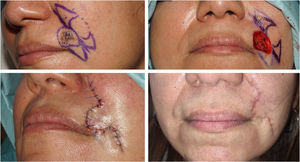 Design (A), execution (B), immediate postoperative (C), and 6-week (D) views of a puzzle flap in the left nasogenian fold. Source: courtesy of Dr. Enrique Rodríguez Lomba.