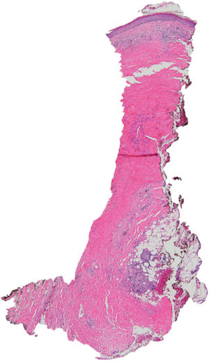 Leg biopsy (hematoxylin–eosin). Flattening of the dermoepidermal junction; thickened dermis with sclerosis and thickened collagen bundles extending into subcutaneous fat. Loss of adnexal structures and a marked decrease in blood vessels are also observed.
