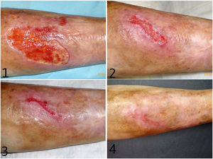 Clinical course with apremilast. At treatment start (1), month 3 (2), month 4 (3), and month 5 (4), showing progressive improvement to complete re-epithelialization of the ulcers.