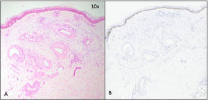 Histología. A. (H-E, 10×): Proliferación no encapsulada mayormente delimitada dérmica de vasos de pared gruesa (correspondientes a telangiectasias no ramificadas objetivables en imagen clínica). B. (Melan-A, 10×): Con técnica inmunohistoquímica Melan-A se observa un lentigo solar suprayacente.