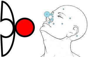 De izquierda a derecha, esquema de la plastia en puzzle y localización de los 30 colgajos en puzzle faciales recogidos en nuestro estudio; los 5 restantes se localizaron fuera del macizo facial.