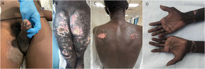 Heterogeneity of skin lesions associated with patera travel. (A) Erosive dermatitis of the glans. (B and C) Superficial scarring in pressure areas. (D) Wrist scars in a patient who was bound during the voyage.