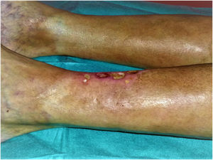 Initial dermatology visit. Well-demarcated, bilateral indurated dyschromic plaques with absence of adnexal structures and ulcers in the affected areas.