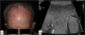 (A) The lesion on the scalp of patient number 2 presented as a partially ulcerated tumor. (B) Ecostructurally normal testes and epididymis in patient number 8, without focal lesions although with marked scrotal edema.