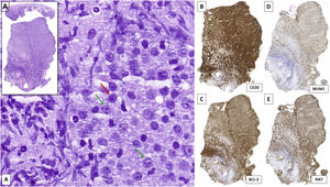 Histopathology of patient number 8. (A) Diffuse lymphocytic proliferation of sheet-like growth with the presence of centroblasts (green arrow) and immunoblasts (red arrow). (B–D) Neoplastic cellularity was positive for CD20, BCL-2 and MUM1, among others. (E) A high proliferative index (Ki-67) was observed.