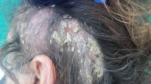 Scarring alopecic plaque on the left temporal region, presenting with a pseudotinea amiantacea appearance.