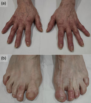 Clinical appearance of the lesions. In addition to the characteristic lesions of osteoarthritis (Heberden