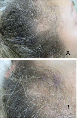 (A) Clinical examination showing marked reduction in hair density in both temporal regions, with preserved eyebrow hair. (B) Overhead view showing bitemporal recession of the frontal hairline and decreased follicular density.