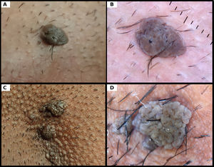 Dermoscopy of two solitary lesions: well-defined lesions with pits or fissures, without pseudocysts, without cerebriform “fingerprint-like” structures, and without melanocytic criteria.