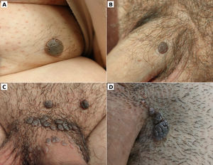 Pigmented condylomas clinically resembling seborrheic keratoses: solitary lesions (A) or multiple lesions (C). Mixed lesions with coexistence of pigmented condylomas and typical condylomas (B and D).
