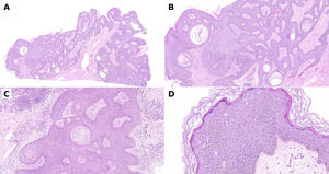 Exophytic, verrucous lesions with horn pseudocysts, basal layer hyperpigmentation, hyperkeratosis, and histologic signs of HPV infection (koilocytes, pseudo-parakeratosis with rounded nuclei in parakeratotic areas).