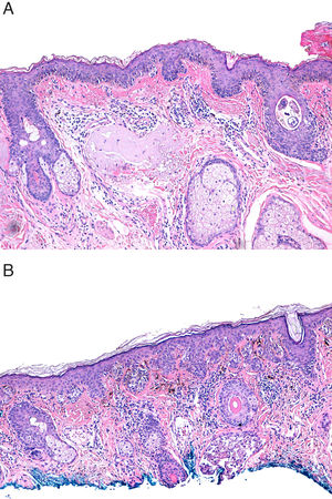 Histological examples of non-acral cutaneous lentiginous melanomas with grade III solar elastosis (A) and grade I solar elastosis (B).