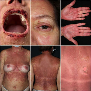 Multiple ill-defined erythematous-purpuric macules coalescing on the anterior trunk and back. Erythema, blisters, and visible skin detachment on the back. Oral and ocular mucositis. Rash affecting the palms of the hands.