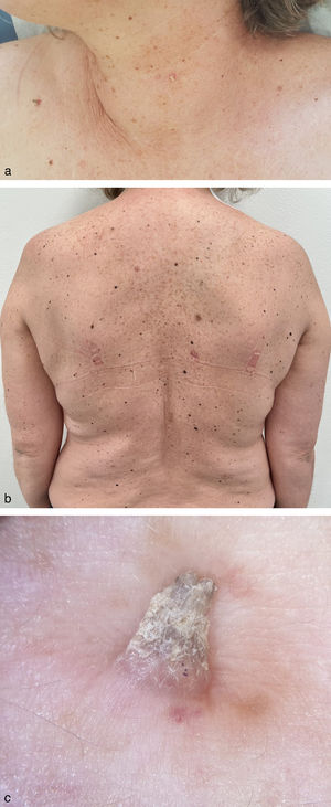 (a) Clinical signs of eruptive BRAF inhibitor–associated verrucous keratosis: yellow-white hyperkeratotic, 2–6mm in size, rounded or filiform papules, scattered around the upper body; (b) Multiple new-onset melanocytic nevi on the back; (c) Dermoscopy of BRAF inhibitor-associated verrucous keratosis: yellow-white hyperkeratotic filiform papule.