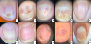Examples of nail changes in the study sample. Image 1 Globular-pattern erythronychia. Image 2. Erythronychia, Beau