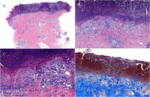 (A–C) H&E stain, 4×/15×/22×. Epidermal hyperplasia, central basophilic plug of keratin, collagen and inflammatory debris. (D) Masson