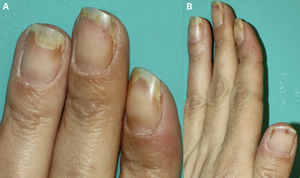 Subungual brownish-black punctate and splinter hemorrhages on the nails. Distal and some lateral onycholysis, detachment of the distal nail plate showing a white or yellowish appearance (A, B).